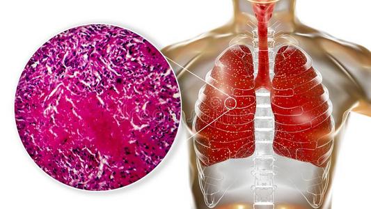 肺结核手抄报图片