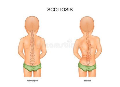 脊柱侧凸采用孩子们照片