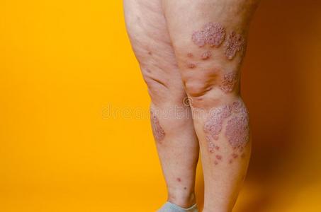 牛皮癣,湿疹,皮炎,阿勒照片
