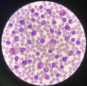 混合血液混合的成熟的白色的血细胞向红色的血细胞背景照片