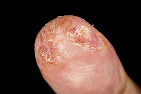 湿疹向男性的拇指宏指令射手照片