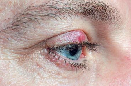 睑板腺囊肿向指已提到的人眼睑关于一m一n关-在上面照片