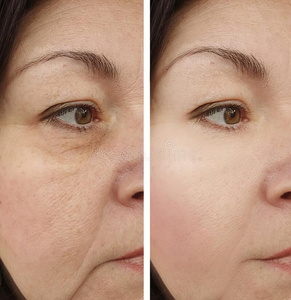 防皱纹女人皱纹在之前和后的对比治疗照片