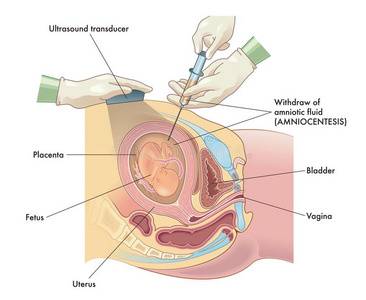 羊膜腔穿刺术引产步骤图片