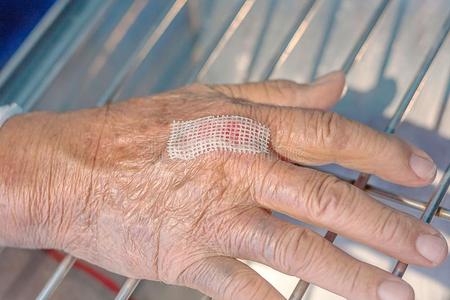 穿衣手创伤照片