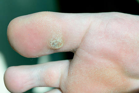 大脚趾肿胀图片