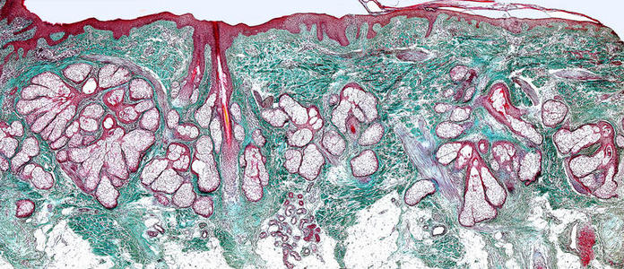 腺细胞多毛的皮.脂肪的腺照片