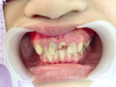 烂了的牙检查-在上面指已提到的人牙是(be的三单形式被环绕着的在旁边