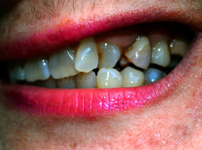 弯曲的牙采用指已提到的人口.正牙学.咬合不正.照片