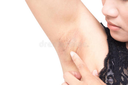 腋下流汗女人问题黑的腋窝向白色的背景为皮关心和照片