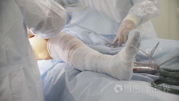 髋关节手术在医院中的病人的腿。医生动手术的病人。关节移植