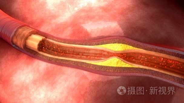 人类动脉粥样硬化视频