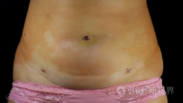 女性腹部与腹腔镜手术后的疤痕视频