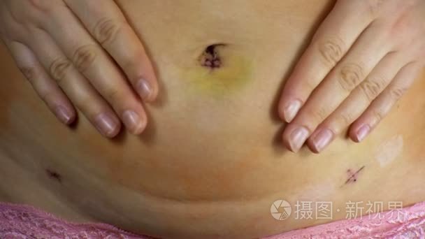 女性腹部与腹腔镜手术后的疤痕视频