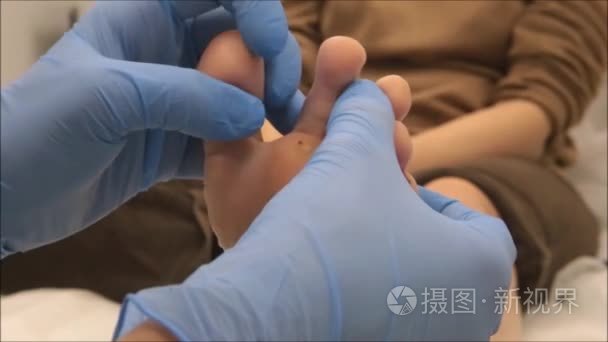 皮肤科医生外科医生检查跖疣视频