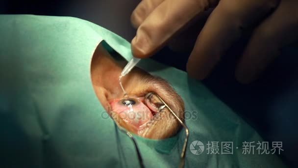 眼睛手术动画视频大全