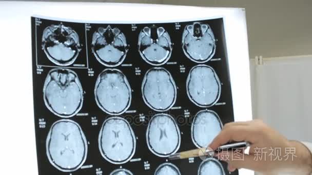 医生检查 Mri 图像的人脑，癌症诊断