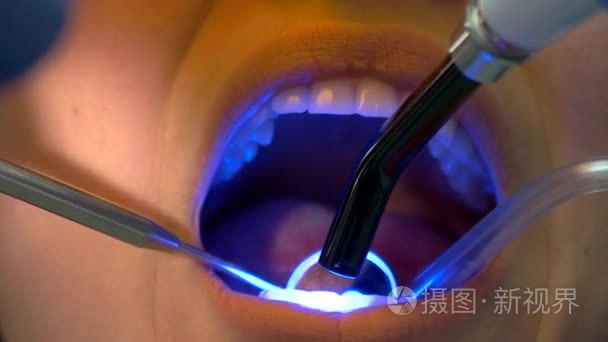 牙科病人和光固化视频