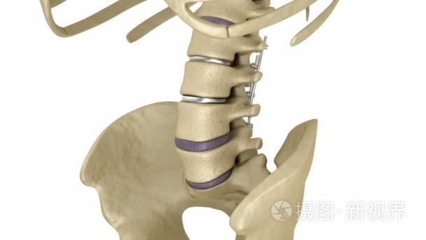 脊柱内固定系统-钛支架。医学上准确牙 3d 动画
