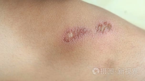 受伤的孩子,在男孩的腿上擦伤的膝盖.特写镜头.