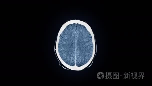 人类的大脑磁共振成像扫描视频