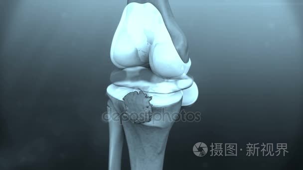 动画的人体膝关节疾病视频