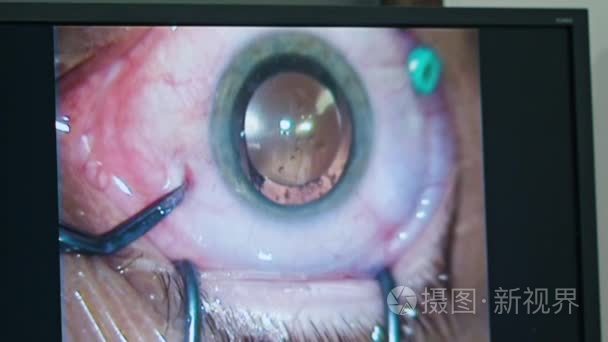 眼科学手术工具内的干预视频