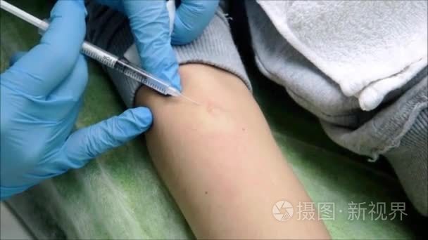 皮肤科医生执行局部麻醉在胳膊上短视频
