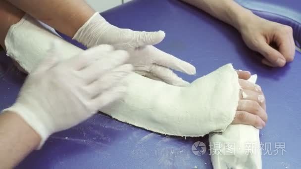 医生抚平创伤部手臂病人的石膏绷带短视频