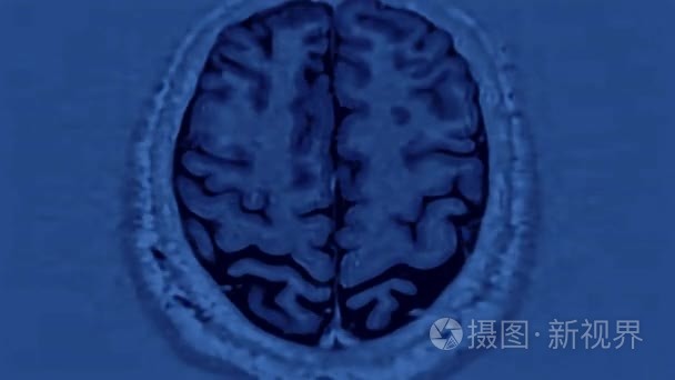 Mri 脑部扫描, 脑部磁共振成像, 超高清 4k, 延时