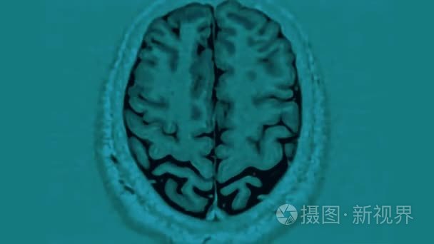 Mri 脑部扫描  脑部磁共振成像  超高清 4k  延时