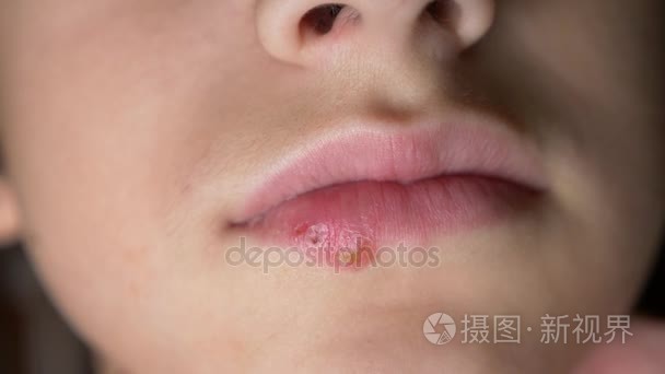 疱疹.唇部治疗4k,慢镜头拍摄,复印空间视频