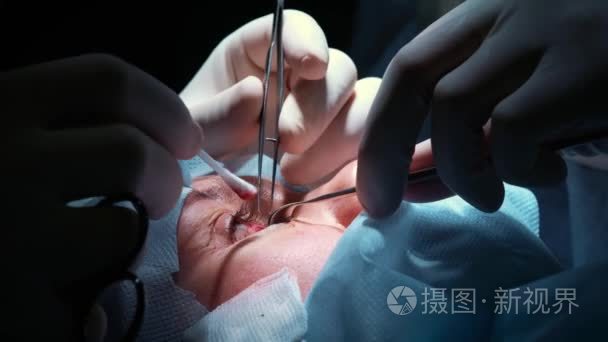 眼科激光手术视频素材