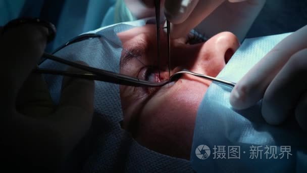 外科医生正在对眼睛进行手术, 特写.眼睛和眼睛的矫正.