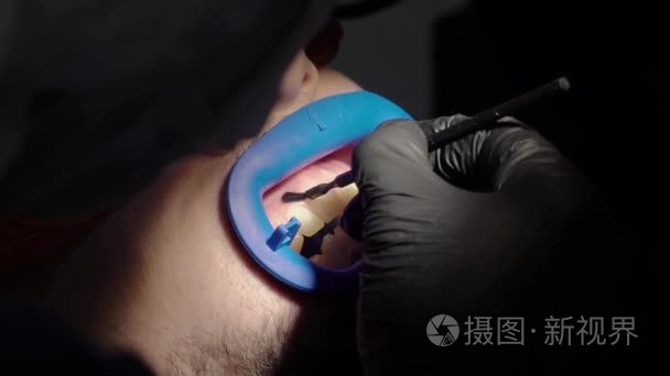 牙医美白牙病人视频