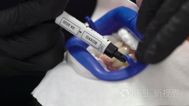 牙医美白牙病人视频