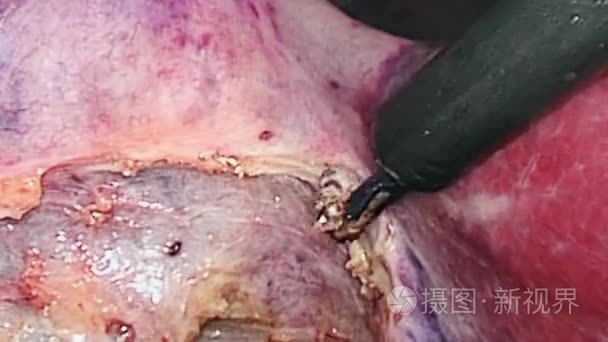 腹腔镜手术中腹腔内腔视频