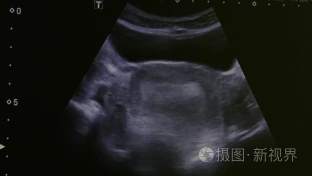 监测超声检查设备中女性子宫的图像