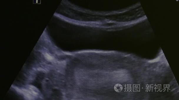 监测超声检查设备中女性子宫的影像学研究