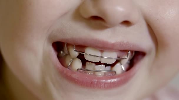 儿童口腔牙齿牙套矫正咬伤, 学龄后幼儿微笑视频