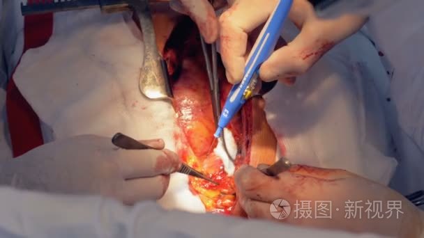 人的心脏被加热的手术刀和钳被切开在操作期间短视频
