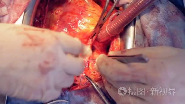 心脏直视手术中静脉和动脉的检查视频