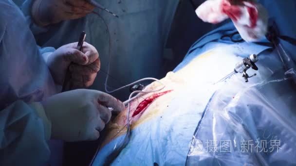 缝合过程中两名外科医生的手视频