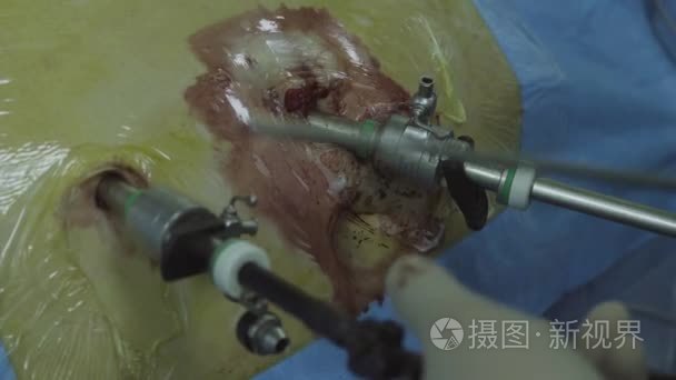 腹腔镜手术病人的腹部视频