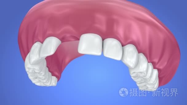 单缺失牙-可摘局部义齿。3d 动画