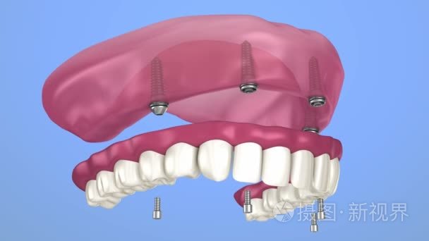 义齿要坐在植入物球附件, 安装过程。3d 动画
