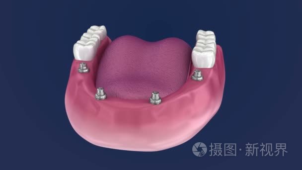 义齿将坐在4植入物-球附件。3d 动画