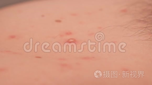成年男性皮肤上的大皮疹或天花的特写。
