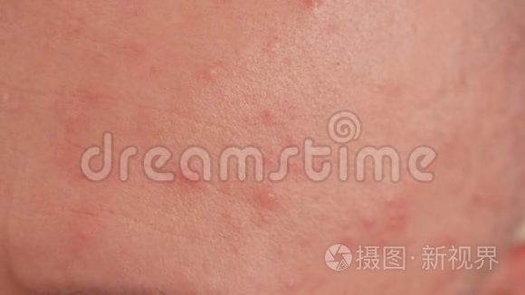 成年男性皮肤上的大皮疹或天花的特写.短视频