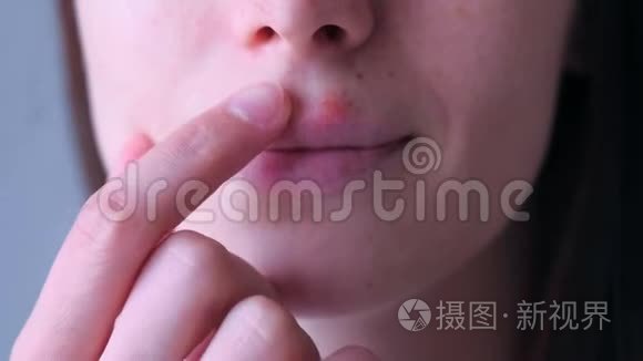 人嘴唇上的疱疹病毒。 女人碰唇口疱疹疮，特写..